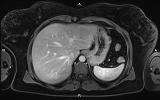 Bilateral adrenal myelolipoma (Radiopaedia 63058-71537 G 20).jpg