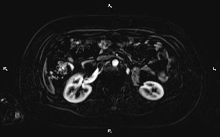 Bilateral adrenal myelolipoma (Radiopaedia 63058-71537 I 51).jpg