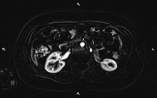 Bilateral adrenal myelolipoma (Radiopaedia 63058-71537 I 52).jpg