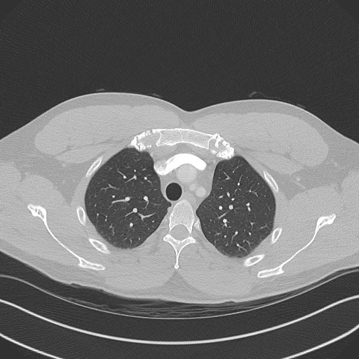 Bilateral atelectasis (Radiopaedia 48666-53675 Axial lung window 24).jpg