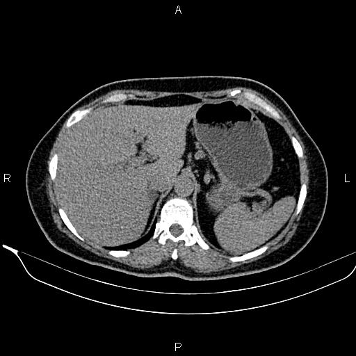 Bilateral benign adrenal adenomas (Radiopaedia 86912-103124 Axial non-contrast 29).jpg