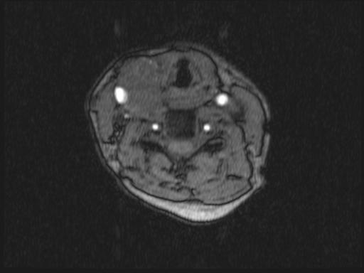 Bilateral carotid body tumors and right glomus jugulare tumor (Radiopaedia 20024-20060 Axial MRA 239).jpg