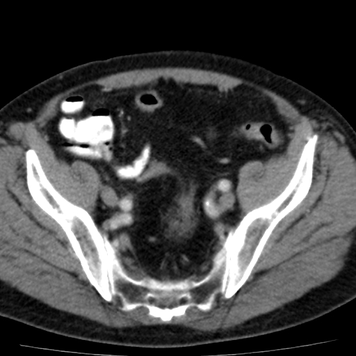 File:Bilateral direct inguinal herniae (Radiopaedia 17016-16719 B 5).jpg