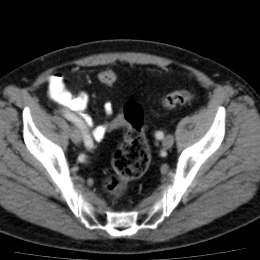 File:Bilateral direct inguinal herniae (Radiopaedia 17016-16719 B 7).jpg