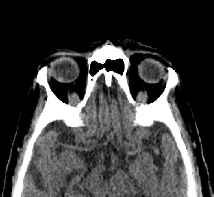 Bilateral ectopia lentis (Radiopaedia 89889-107013 Axial non-contrast 22).jpg