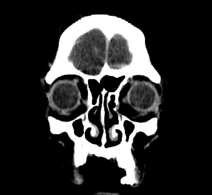 Bilateral ectopia lentis (Radiopaedia 89889-107013 Coronal non-contrast 23).jpg