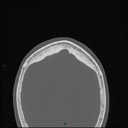 File:Bilateral frontal mucoceles (Radiopaedia 82352-96454 Axial bone window 1).jpg