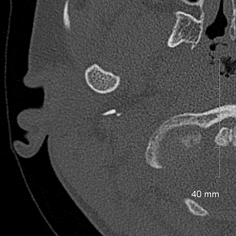 Bilateral grommets (Radiopaedia 47710-52404 Axial bone window 1).jpg