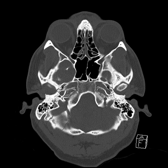 Bilateral occipital condyle fracture (type 2) (Radiopaedia 87675-104089 Axial bone window 22).jpg