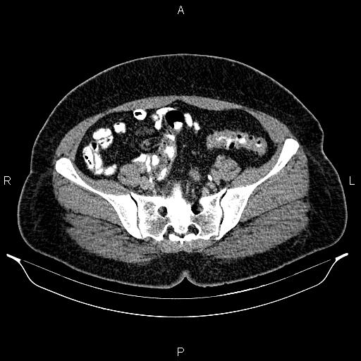 Bilateral ovarian dermoid cysts (Radiopaedia 85785-101603 Axial C+ delayed 62).jpg