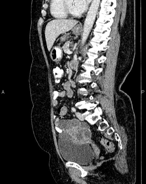 Bilateral ovarian serous cystadenocarcinoma (Radiopaedia 86062-101989 E 49).jpg