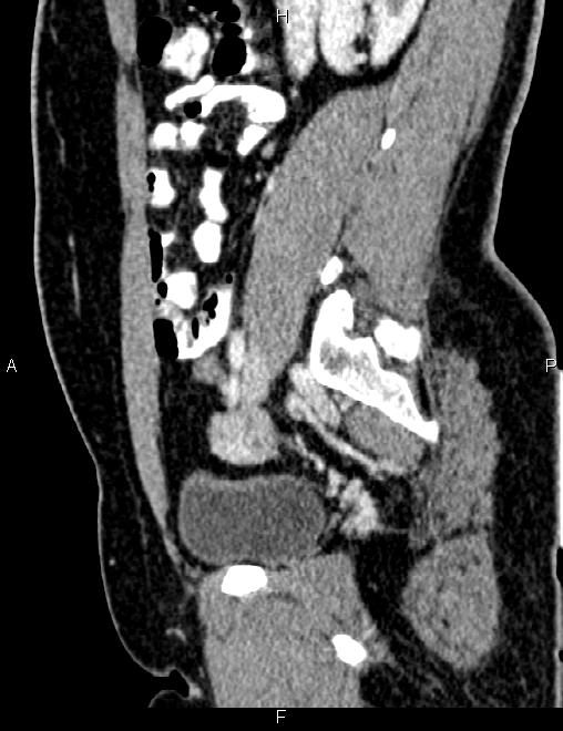 Bilateral ovarian teratoma (Radiopaedia 83131-97503 D 50).jpg