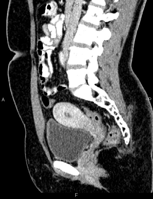 Bilateral ovarian teratoma (Radiopaedia 83131-97503 D 58).jpg
