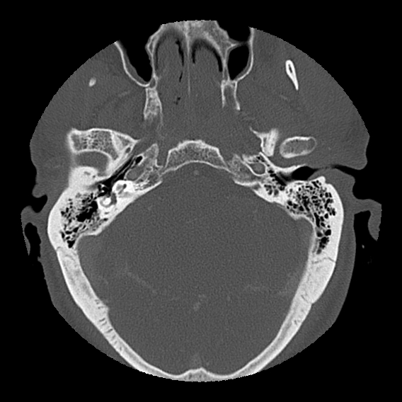 File:Bilateral perched facets with cord injury (Radiopaedia 45587-49713 Axial bone window 7).jpg
