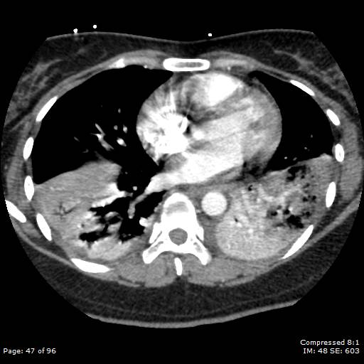 Bilateral pulmonary emboli with Hampton hump sign (Radiopaedia 54070-60246 Axial C+ CTPA 44).jpg