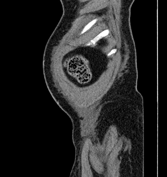 Bilateral rectus sheath hematomas (Radiopaedia 50778-56252 B 7).jpg