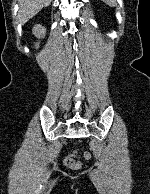 Bilateral staghorn calculi (Radiopaedia 59475-66842 Coronal non-contrast 83).jpg