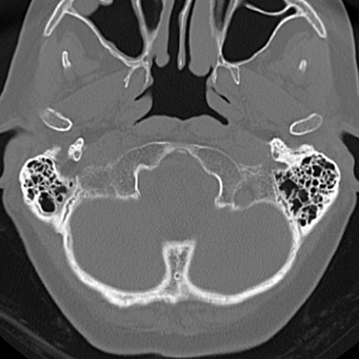 File:Bilateral tympanoplasty (Radiopaedia 16947-16664 Axial bone window 30).jpg