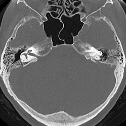 File:Bilateral tympanoplasty (Radiopaedia 16947-16664 Axial bone window 9).jpg