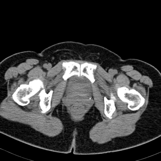 Bilateral ureteric stents (Radiopaedia 48795-53825 Axial non-contrast 69).jpg