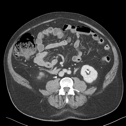 File:Bladder papillary urothelial carcinoma (Radiopaedia 48119-52951 Axial 29).png