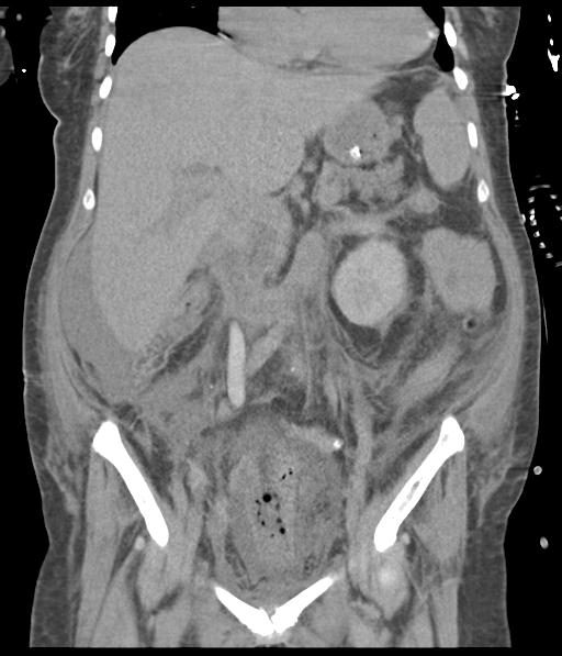 Bladder rupture post renal biopsy (Radiopaedia 30863-31572 Coronal non-contrast 29).jpg