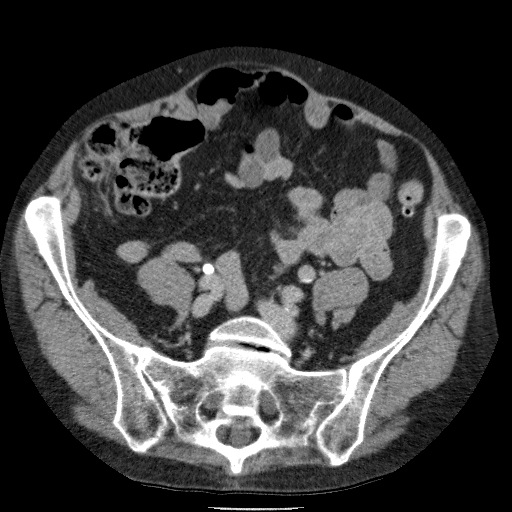 Bladder tumor detected on trauma CT (Radiopaedia 51809-57609 C 97).jpg