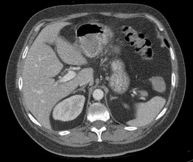 Bleeding duodenal ulcer and adenomyomatosis of gallbladder (Radiopaedia 61834-69861 A 29).jpg