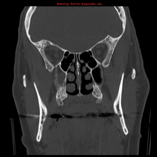 File:Blowout fracture with inferior rectus entrapment (Radiopaedia 12418-12673 Coronal bone window 14).jpg