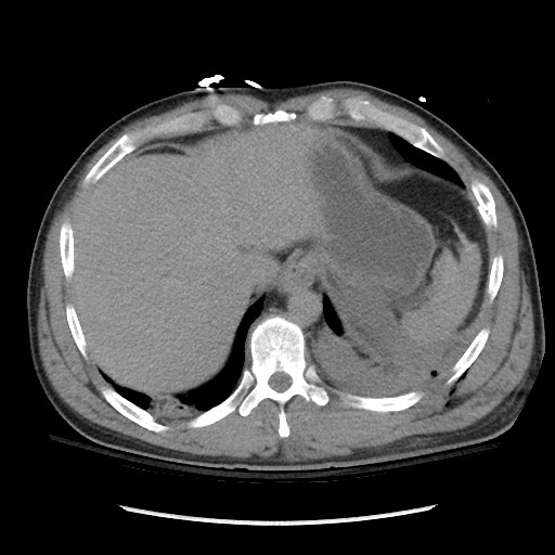 Blunt abdominal trauma with solid organ and musculoskelatal injury with active extravasation (Radiopaedia 68364-77895 Axial C+ delayed 24).jpg