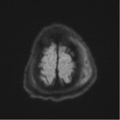 Blunt cerebrovascular injury (Radiopaedia 53682-59745 Axial DWI 57).png