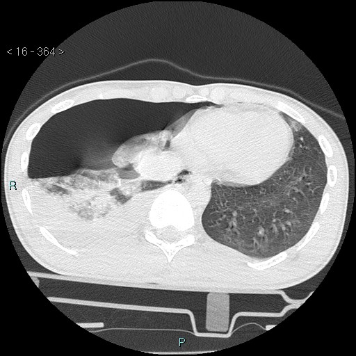 Blunt chest trauma (Swiss cheese sign) (Radiopaedia 38519-40618 Axial lung window 64).jpg