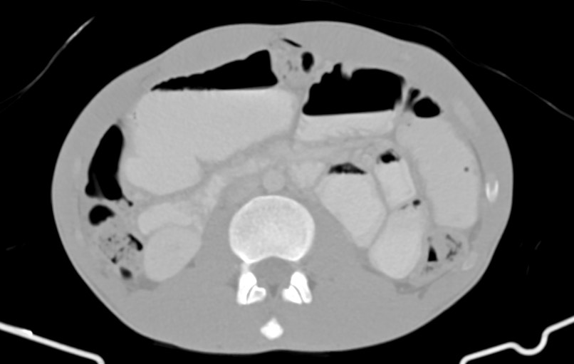 Blunt injury to the small bowel (Radiopaedia 74953-85987 Axial Wide 38).jpg