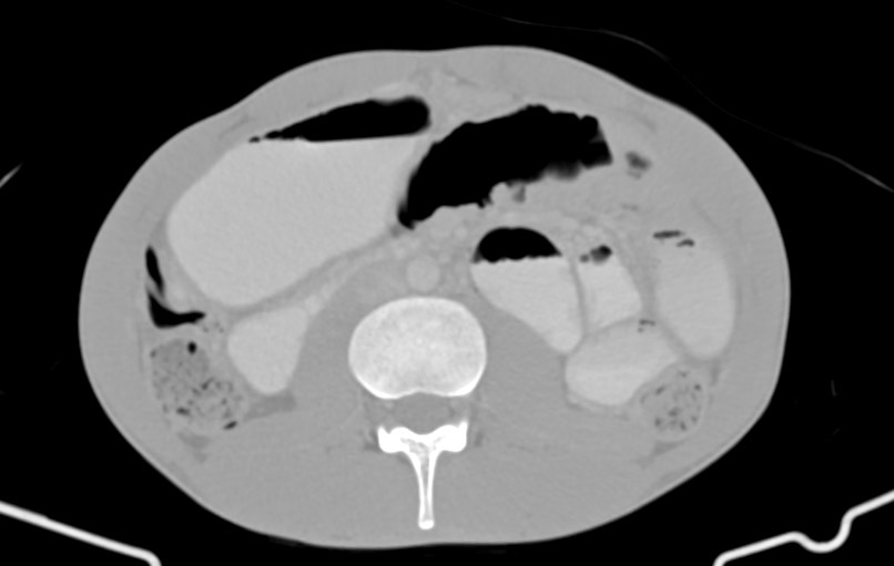 Blunt injury to the small bowel (Radiopaedia 74953-85987 Axial Wide 43).jpg