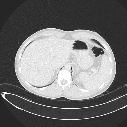File:Boerhaave syndrome with mediastinal, axillary, neck and epidural free gas (Radiopaedia 41297-44115 Axial lung window 78).jpg
