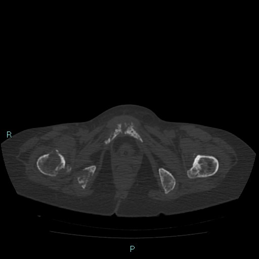 Bone metastases from untreated breast cancer (Radiopaedia 42973-46219 Axial bone window 198).jpg