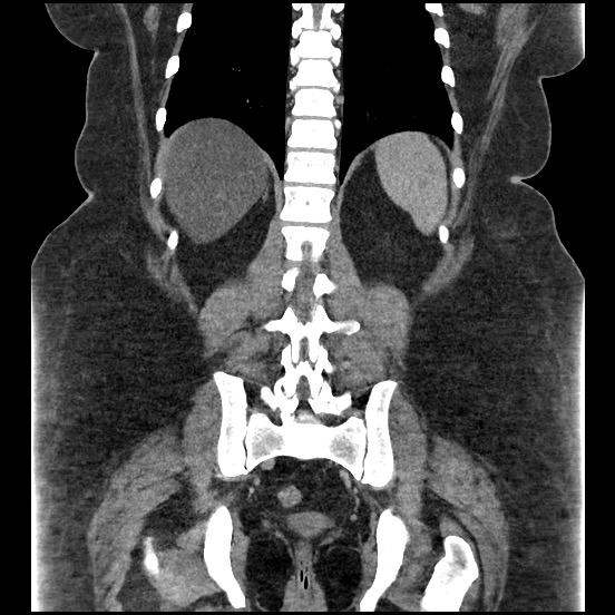 File:Bowel and splenic infarcts in acute lymphocytic leukemia (Radiopaedia 61055-68913 B 44).jpg
