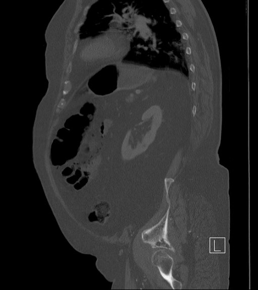 Bowel ischemia secondary to SMA occlusion with extensive portomesenteric venous gas (Radiopaedia 54656-60871 Sagittal bone window 28).jpg
