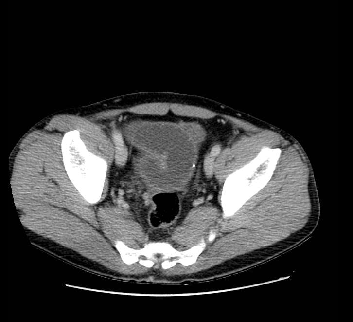 Bowel obstruction from colon carcinoma (Radiopaedia 22995-23028 A 74).jpg