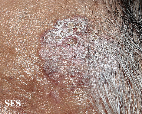 Bowen'S Disease (Dermatology Atlas 6).jpg