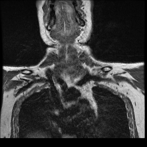 File:Brachial plexus neurofibroma (Radiopaedia 28030-28291 Coronal T1 14).png