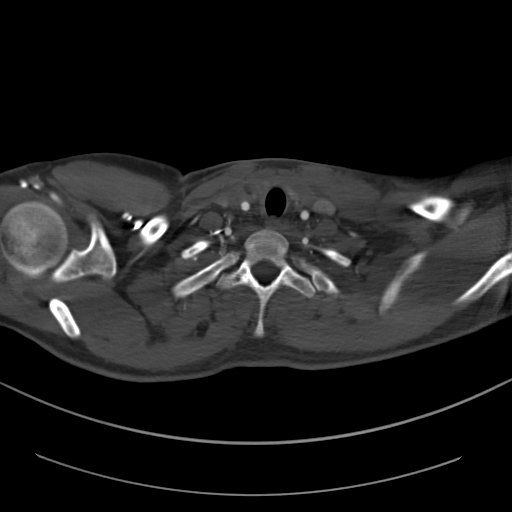 Brachiocephalic trunk pseudoaneurysm (Radiopaedia 70978-81191 Axial bone window 42).jpg