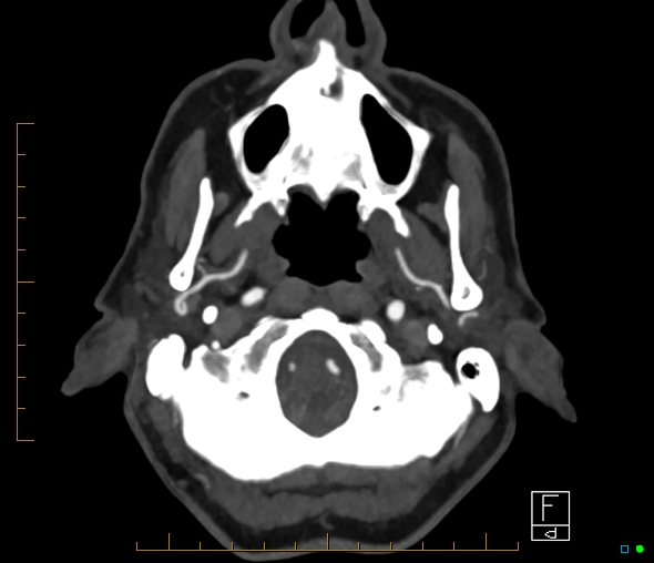Brachiocephalic trunk stenosis (Radiopaedia 87242-103519 A 64).jpg