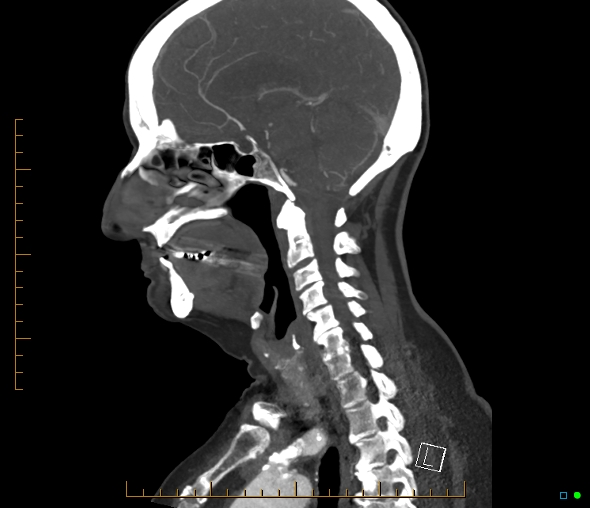 Brachiocephalic trunk stenosis (Radiopaedia 87242-103519 C 35).jpg