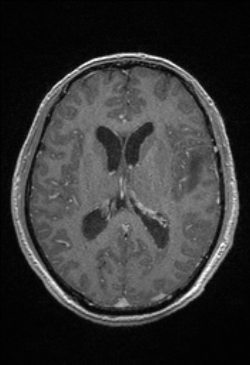 Brain abscess with ventriculitis (Radiopaedia 85703-101495 Axial T1 C+ 101).jpg
