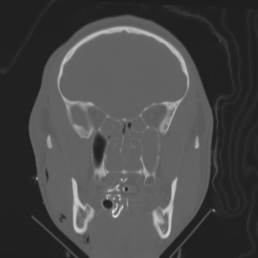Brain contusions, internal carotid artery dissection and base of skull fracture (Radiopaedia 34089-35339 Coronal bone window 25).png