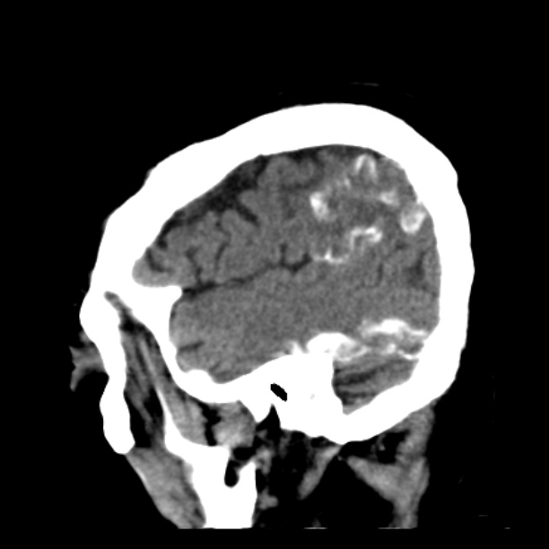 Brain cortical laminar necrosis (Radiopaedia 25822-25971 non-contrast 41).jpg
