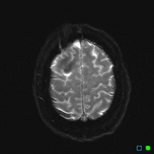 File:Brain death on MRI and CT angiography (Radiopaedia 42560-45689 Axial ADC 27).jpg