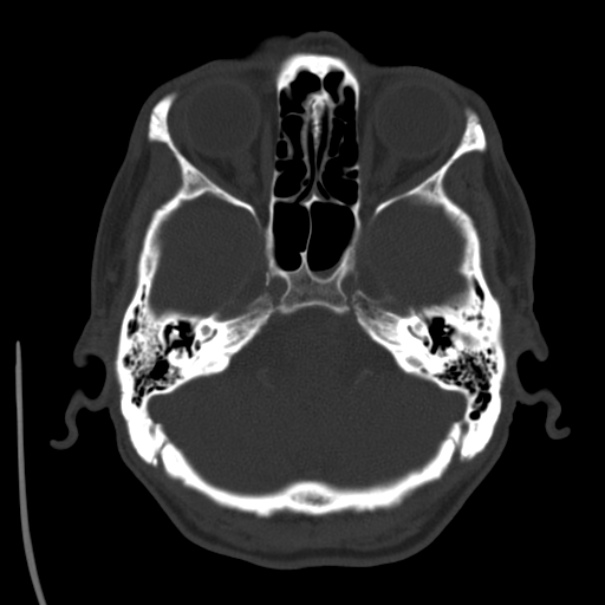 Brain metastases from lung cancer (Radiopaedia 24480-24781 Axial bone window 9).jpg