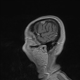 Brain metastasis (Radiopaedia 42617-45761 Sagittal T1 C+ 11).jpg